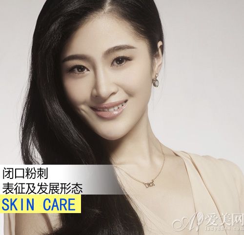 杜绝 闭口粉刺 形成 还原平整光滑肌肤_消费_南