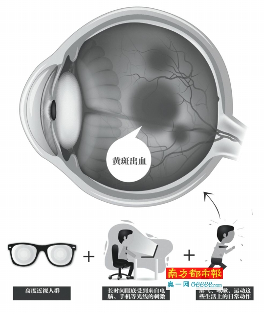 20岁大学生玩网游8小时左眼险失明_广州